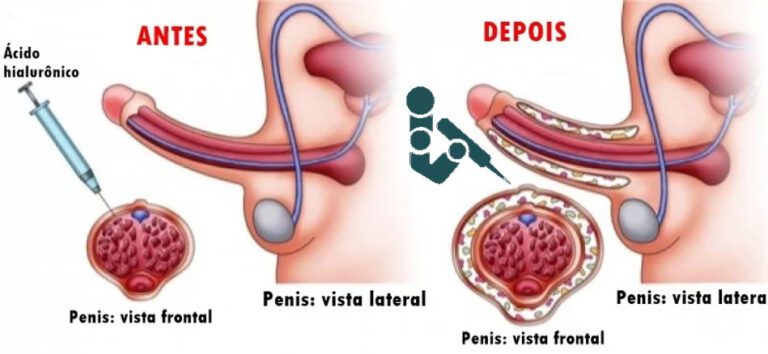 Tudo que você precisa saber sobre PREENCHIMENTO PENIANO - Dr. Rodrigo ...