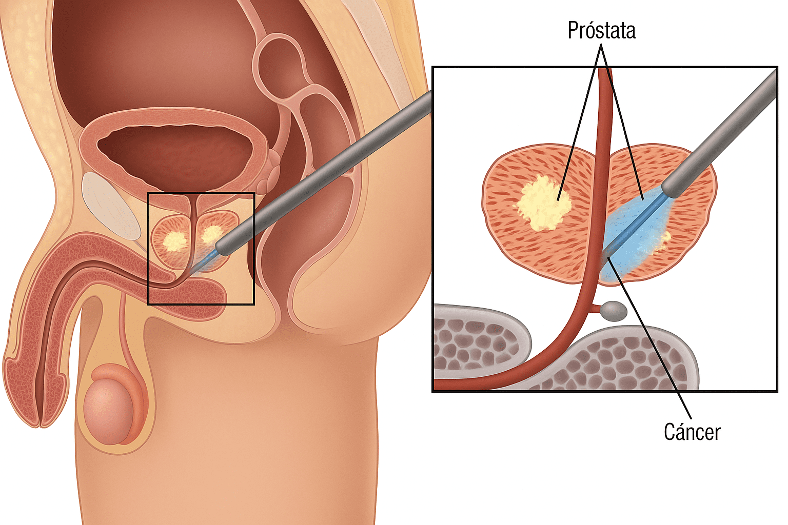 LINFADENECTOMIA RETROPERITONEAL